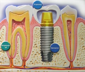 Зубные импланты: виды и их особенности